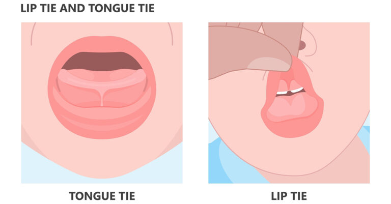 Lip And Tongue Tie Graphic